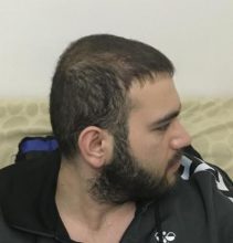 fue-hair-transplant-turkey (1)