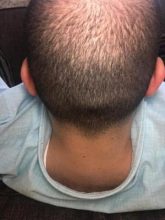 fue-hair-transplant-turkey (10)