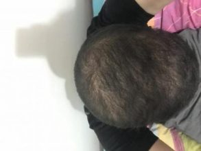 fue-hair-transplant-turkey (11)
