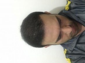fue-hair-transplant-turkey (12)