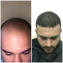 fue-hair-transplant-turkey (13)