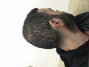 fue-hair-transplant-turkey (14)