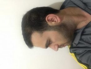 fue-hair-transplant-turkey (15)