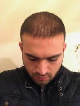 fue-hair-transplant-turkey (16)