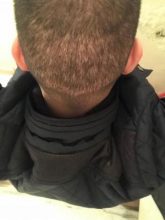fue-hair-transplant-turkey (17)