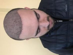 fue-hair-transplant-turkey (18)