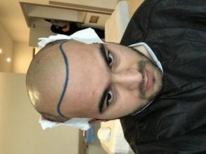 fue-hair-transplant-turkey (19)