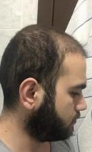 fue-hair-transplant-turkey (20)