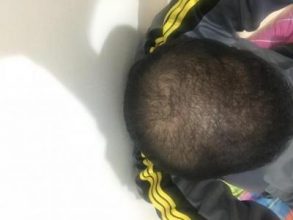 fue-hair-transplant-turkey (21)