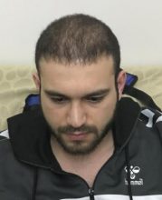 fue-hair-transplant-turkey (22)