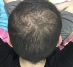 fue-hair-transplant-turkey (23)