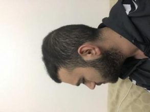 fue-hair-transplant-turkey (24)
