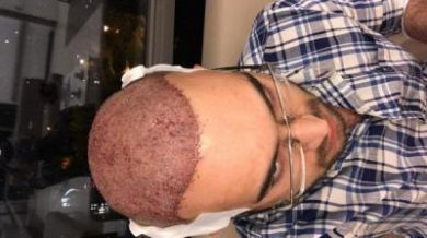 fue-hair-transplant-turkey (25)
