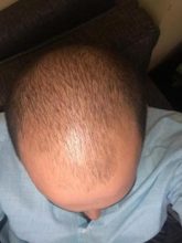 fue-hair-transplant-turkey (26)