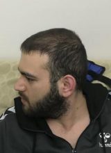 fue-hair-transplant-turkey (27)