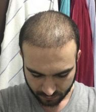 fue-hair-transplant-turkey (28)