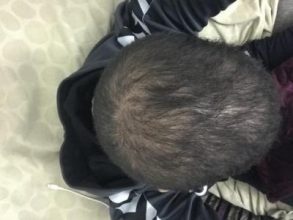 fue-hair-transplant-turkey (29)
