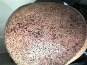 fue-hair-transplant-turkey (3)
