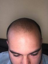 fue-hair-transplant-turkey (30)