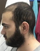 fue-hair-transplant-turkey (4)