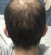 fue-hair-transplant-turkey (7)