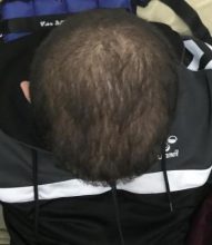 fue-hair-transplant-turkey (8)