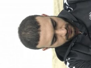fue-hair-transplant-turkey (9)
