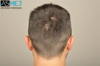 hair-plantation-turkey (1)