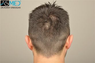 hair-plantation-turkey (2)