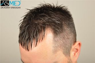 hair-plantation-turkey (3)