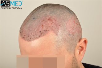 hair-plantation-turkey (4)