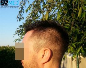 hair-plantation-turkey (5)