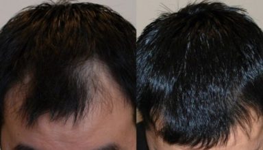hair-plugs-turkey (1)