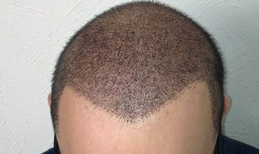 hair-plugs-turkey (4)