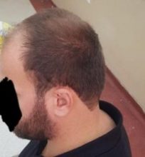 hair regrowth (1)