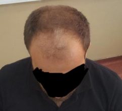 hair-regrowth