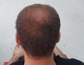 hair regrowth (3)