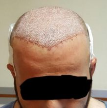 hair regrowth (4)