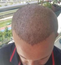 hair regrowth (5)