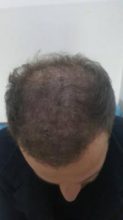 hair regrowth (6)