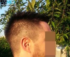 hair-replacement-turkey (1)