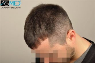 hair-replacement-turkey (2)