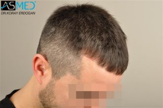 hair-replacement-turkey (3)