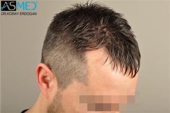 hair-replacement-turkey (4)