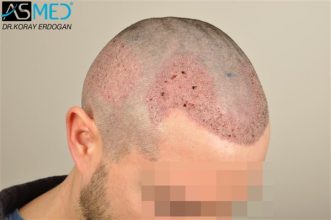 hair-replacement-turkey (5)
