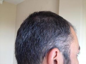 hair-restoration-in-turkey (10)