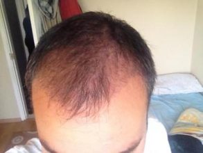 hair-restoration-in-turkey (11)