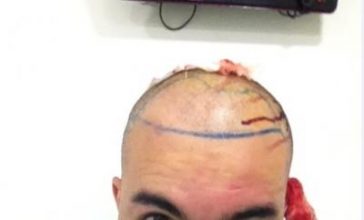 hair-restoration-in-turkey (12)