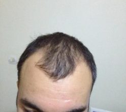 hair-restoration-in-turkey (2)
