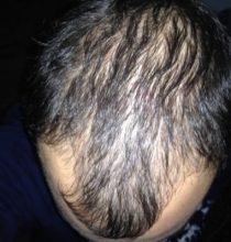 hair-restoration-in-turkey (3)